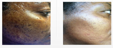 acne-scars-woodland-hills.png