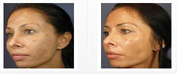 remove-wrinkles-fine-lines-woodland-hills.png