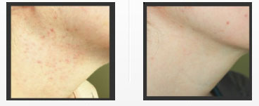 acne-scars-treatment.png