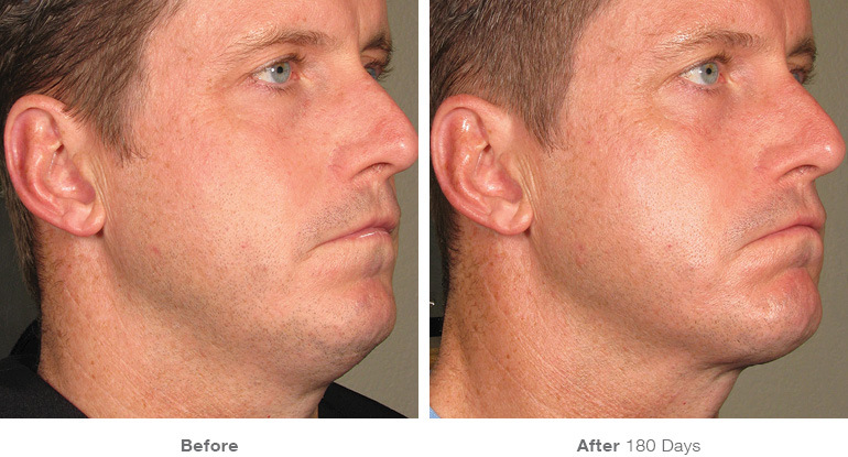 before_after_ultherapy_results_full-face16.jpg