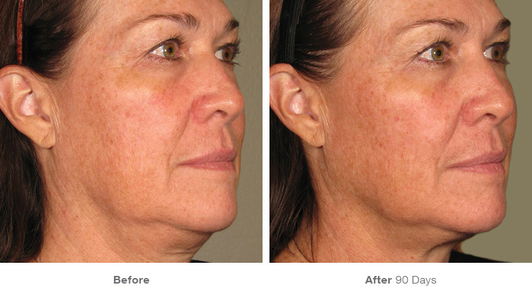 before_after_ultherapy_results_full-face20.jpg