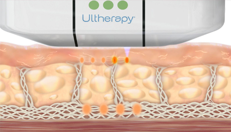 Animation of How Ultherapy Stimulates Collagen Production at Different Layers - Skin Tightening - WEB.jpg